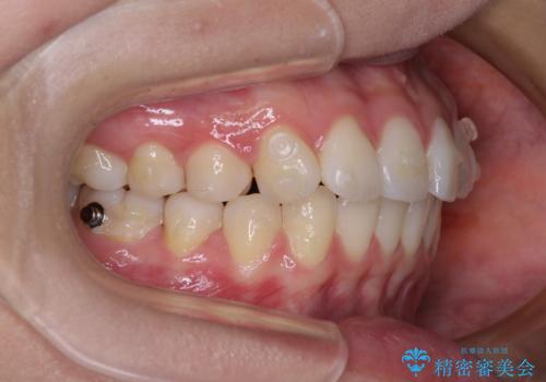 前歯のデコボコを解消 インビザラインの矯正治療の治療中