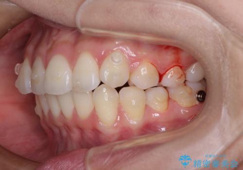 前歯のデコボコを解消 インビザラインの矯正治療の治療中