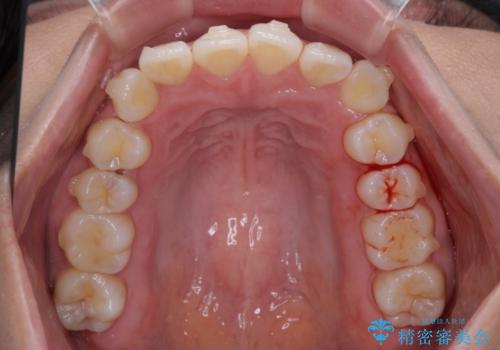前歯のデコボコを解消　インビザラインの矯正治療の治療中