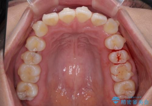 前歯のデコボコを解消 インビザラインの矯正治療の治療中