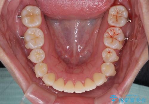 前歯のデコボコを解消 インビザラインの矯正治療の治療中