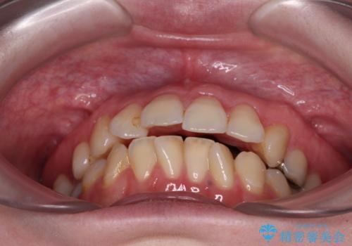 開咬と前方に飛び出した前歯 インビザラインによる矯正治療の治療前