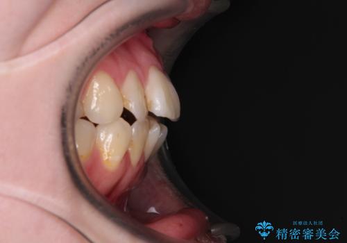 開咬と前方に飛び出した前歯 インビザラインによる矯正治療の治療前