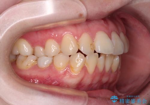 開咬と前方に飛び出した前歯 インビザラインによる矯正治療の治療前
