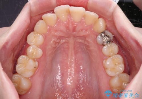 開咬と前方に飛び出した前歯 インビザラインによる矯正治療の治療前