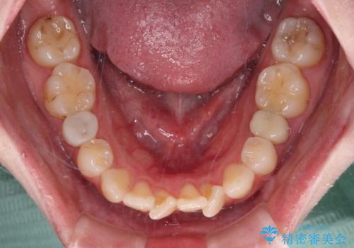 開咬と前方に飛び出した前歯 インビザラインによる矯正治療の治療前