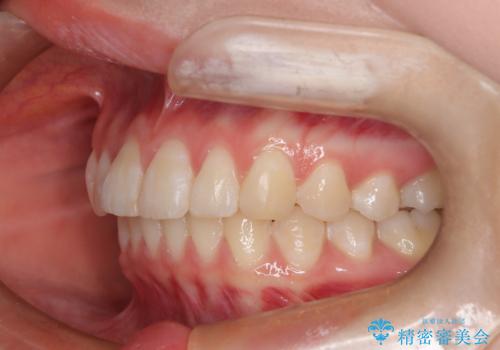 前歯のガタつきを治したい 翼状捻転マウスピース矯正の治療後