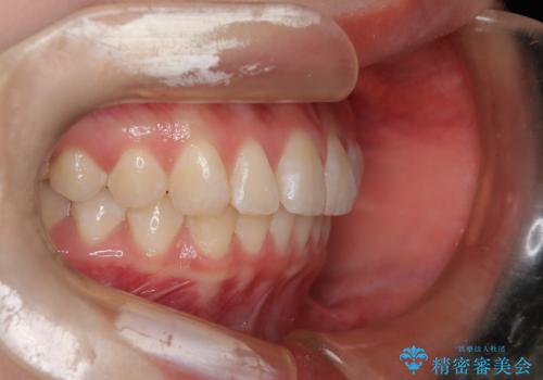 前歯のガタつきを治したい 翼状捻転マウスピース矯正の治療後