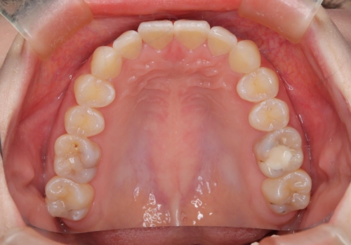 前歯のガタつきを治したい　翼状捻転マウスピース矯正の治療後