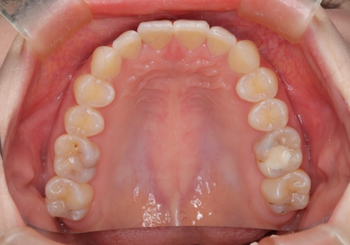 前歯のガタつきを治したい 翼状捻転マウスピース矯正の治療後