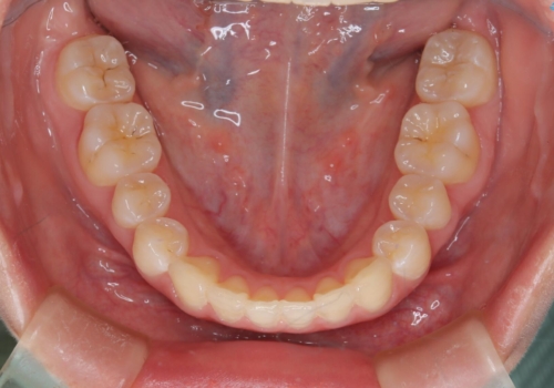 前歯のガタつきを治したい 翼状捻転マウスピース矯正の治療後