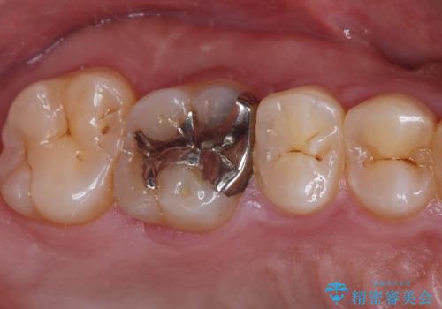 銀歯を白くしたい セラミックインレー修復の治療前