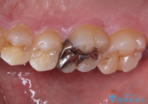 銀歯を白くしたい セラミックインレー修復の治療前