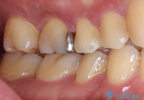 銀歯を白くしたい セラミックインレー修復の治療前