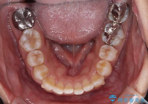 インビザライン・モデレートを用いて気になる前歯を短期間で矯正治療の治療中