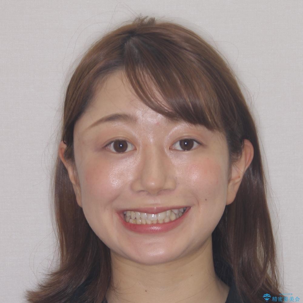 【モニター】顎のゆがみをカムフラージュ ワイヤー装置の抜歯矯正の治療前(顔貌)