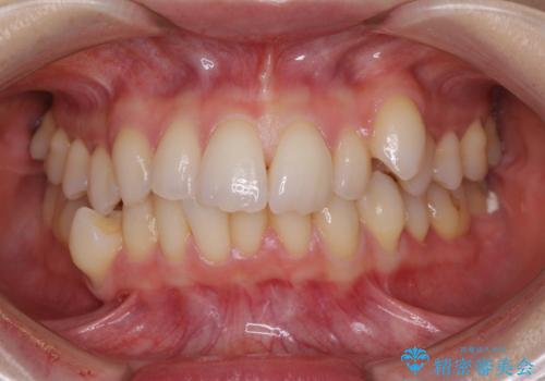 【モニター】顎のゆがみをカムフラージュ　ワイヤー装置の抜歯矯正の症例 治療前