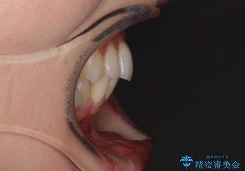 【モニター】顎のゆがみをカムフラージュ ワイヤー装置の抜歯矯正の治療前