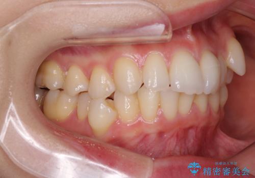 【モニター】顎のゆがみをカムフラージュ ワイヤー装置の抜歯矯正の治療前