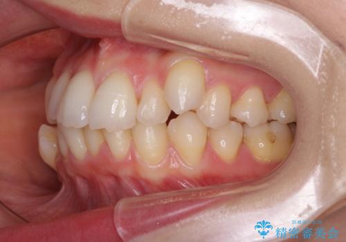 【モニター】顎のゆがみをカムフラージュ ワイヤー装置の抜歯矯正の治療前