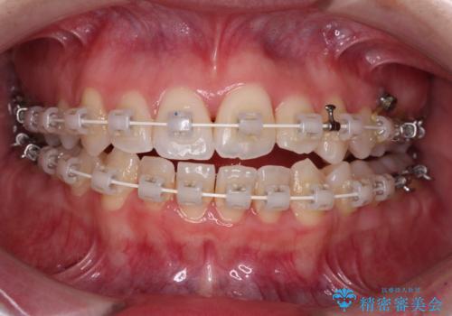 骨格的な問題を側方拡大で解決　ワイヤー矯正治療の治療中