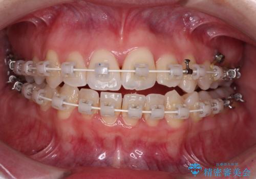 骨格的な問題を側方拡大で解決 ワイヤー矯正治療の治療中