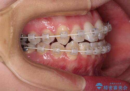 骨格的な問題を側方拡大で解決 ワイヤー矯正治療の治療中