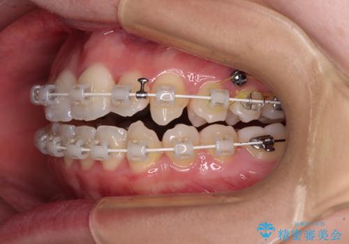 骨格的な問題を側方拡大で解決　ワイヤー矯正治療の治療中