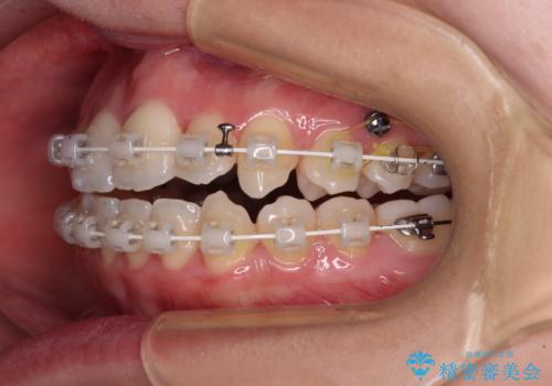 骨格的な問題を側方拡大で解決 ワイヤー矯正治療の治療中