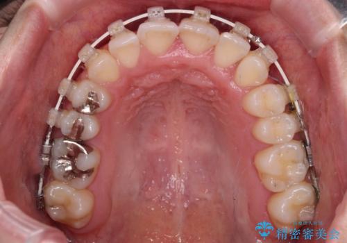 骨格的な問題を側方拡大で解決　ワイヤー矯正治療の治療中