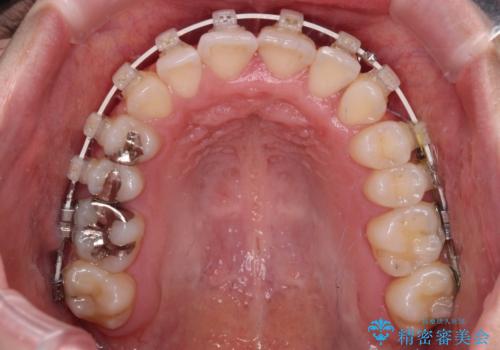 骨格的な問題を側方拡大で解決 ワイヤー矯正治療の治療中