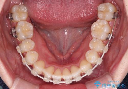 骨格的な問題を側方拡大で解決 ワイヤー矯正治療の治療中