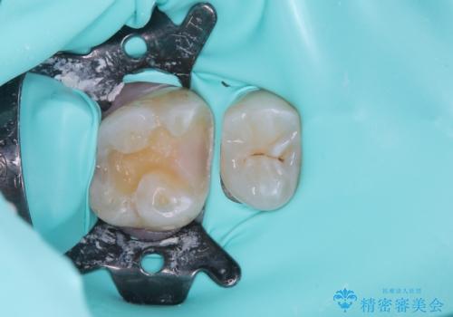 銀歯を白くしたい セラミックインレー修復の治療中