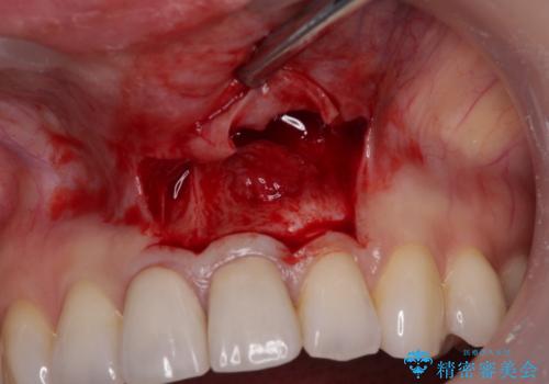 膿の出口が気になるセラミッククラウンの前歯　歯根端切除術で解決の治療中