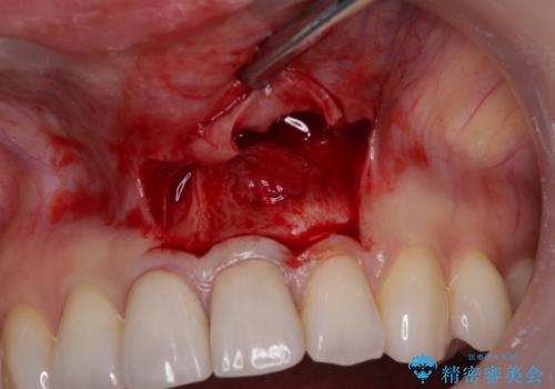 膿の出口が気になるセラミッククラウンの前歯 歯根端切除術で解決の治療中