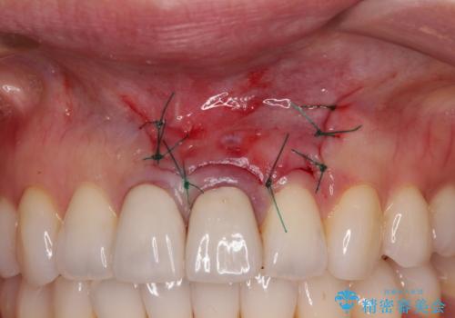 膿の出口が気になるセラミッククラウンの前歯　歯根端切除術で解決の治療後
