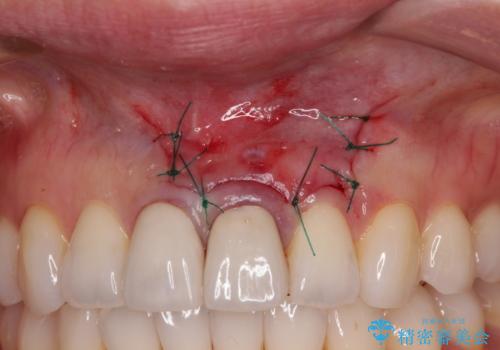 膿の出口が気になるセラミッククラウンの前歯 歯根端切除術で解決の治療後