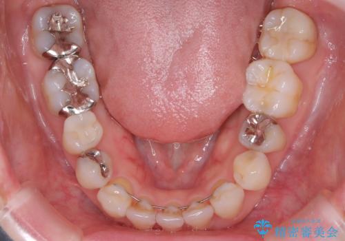 【セラミックインレー】口の中を白くしたい