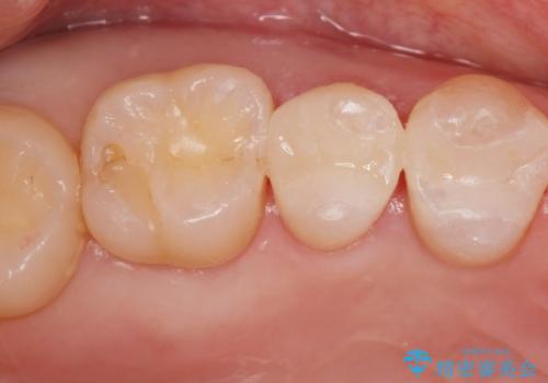 虫歯の再発リスクが高い樹脂修復部分をe-maxインレーにの症例 治療後
