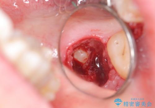 親知らず、過剰歯抜歯の抜歯の治療中