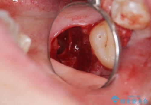 親知らず、過剰歯抜歯の抜歯の治療後