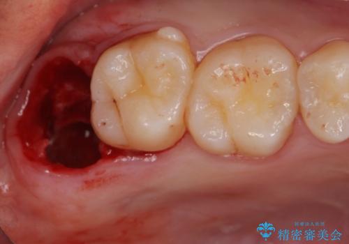 親知らず、過剰歯抜歯の抜歯の治療後