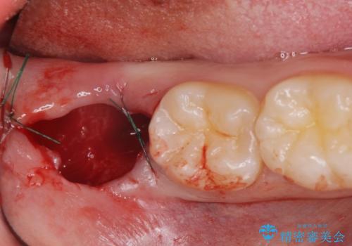 親知らず、過剰歯抜歯の抜歯の治療後