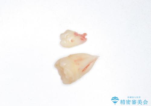 親知らず、過剰歯抜歯の抜歯の治療中