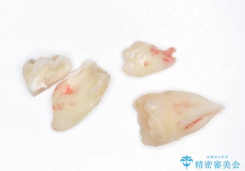 親知らず、過剰歯抜歯の抜歯の治療中