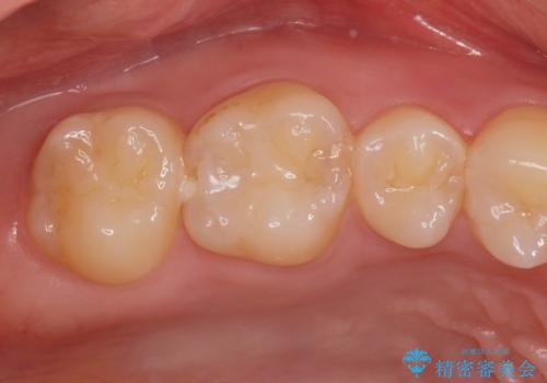 コンタクトカリエスの治療。(e-maxインレー)の治療前