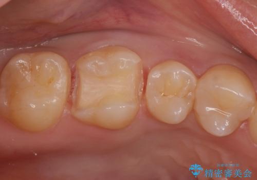 コンタクトカリエスの治療。(e-maxインレー)の治療中
