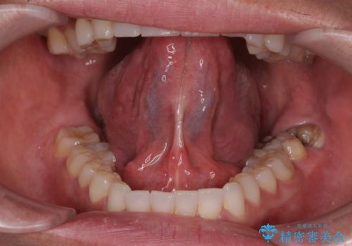 舌小帯切除術の症例 治療前