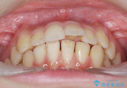 [ インビザラインライト ]    3.5ヶ月で行う前歯だけのマウスピース矯正の症例 治療前