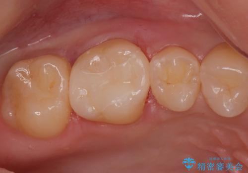 コンタクトカリエスの治療。(e-maxインレー)の治療後